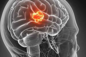 Glioblastoma, entro un anno a Napoli sperimentazione pillole ozono
